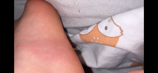 Insect Bite Diagnosis help!