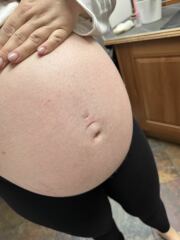 Help! The most awful and itchy rash on my bump!
