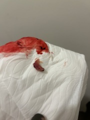 5 weeks past conception (7weeks nhs) early miscarriage *[pic included]