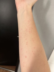 Itchy rash first trimester