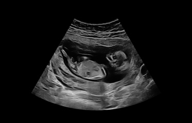 Umbilical cord or boy?
