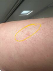 Weird brown mole?