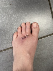 Infected stitches?