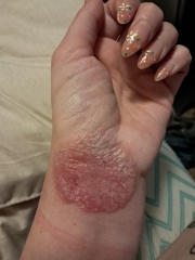 Contact Dermatitis? Please help!