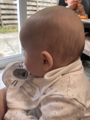 Is this plageocephaly?