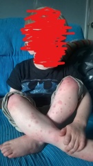Help please - persistent low grade fevers and Petechiae two year old