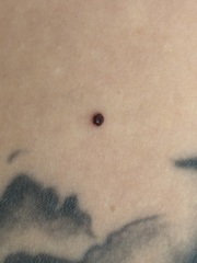 Could this be melanoma?????