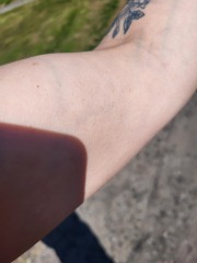 Petechiae or cherry angioma? Talk me down