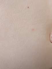 Chickenpox?