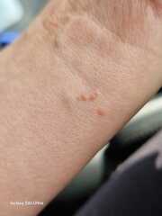 What are these on my hands and wrists?