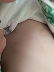 Chickenpox?