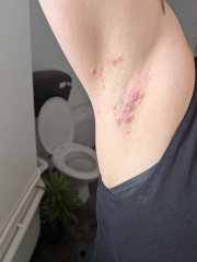 Rapidly spreading skin infection under arm. Help. (Photo warning)