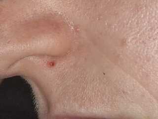 Coldsore or spots?