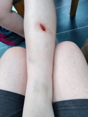 Any wound experts out there? (includes pic - warning!)
