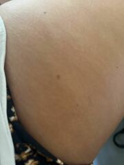 Are these moles..?