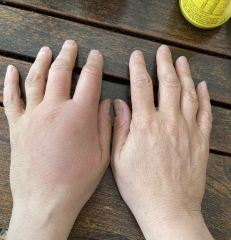 When to worry about an insect bite?