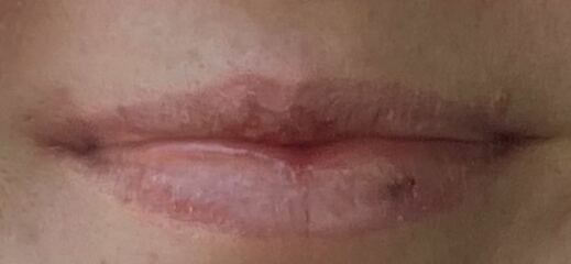 How to heal bruise on lip that’s been there years? Pics