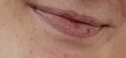 How to heal bruise on lip that’s been there years? Pics