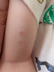 Chickenpox?