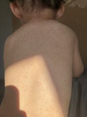 rash appeared 4 days ago on my son