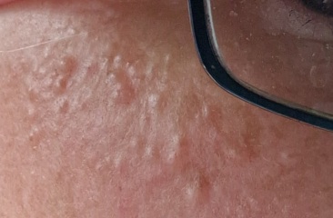 Help! Millia or syringomas or Sebaceous Hyperplasia