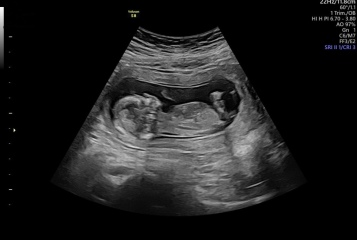 13.3 scan today 🤍