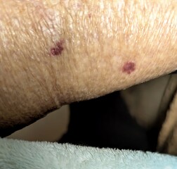 Mysterious Spots Under my Skin