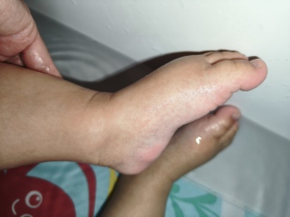 What is this rash please?