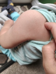 What is this rash please?