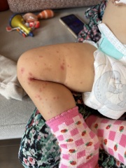 Please can anyone help ?! In hospital abroad with sick baby ( graphic pictures)