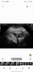 Baby gender 16 weeks scan