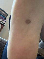 Moles / mark on sole of foot