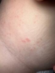 Chicken pox?