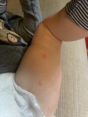 Is this chicken pox or viral rash?