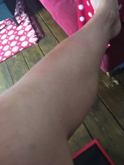 Insect bite