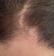 Hair loss with pic