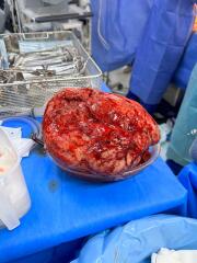 Fibroids during pregnancy