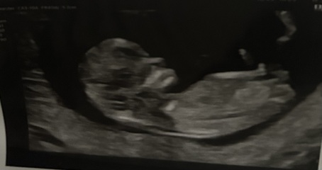 11 weeks 3 days boy or girl?