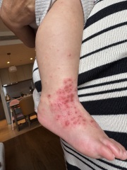 Please can anyone help ?! In hospital abroad with sick baby ( graphic pictures)