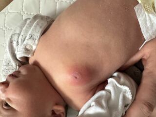 Swollen Breast in newborn