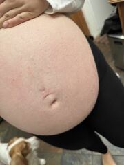 Help! The most awful and itchy rash on my bump!