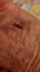 Do I need an antibiotic?