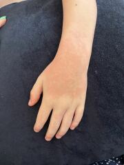 Is this heat rash or a reaction?