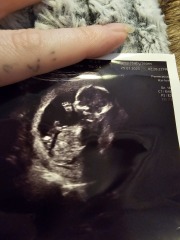 Placenta position?
