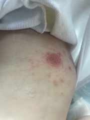 Any ideas what this rash is?