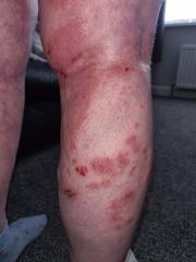 Burning and painful skin.