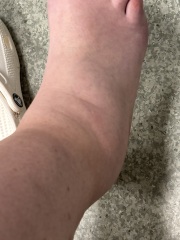 Foot bruising and swelling after 3.5 weeks