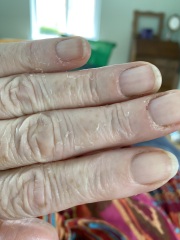 Photo, peeling hands and feet. Any ideas?