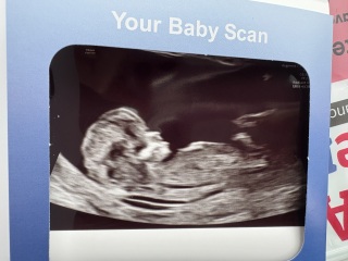 12 week scan🤍 What do we think 🤍