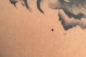 Could this be melanoma?????